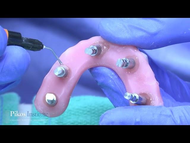 Fully Guided Full Arch - Digitally Guided Full Arch All on 4 Surgery