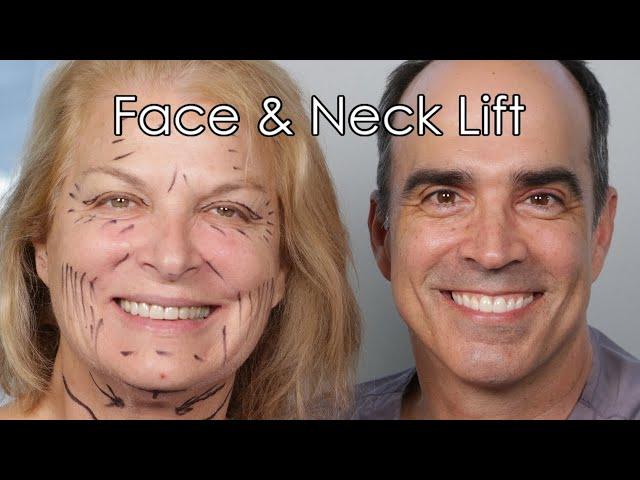 Facelift Los Angeles: Top Plastic Surgeon Dr. David Stoker on Facelift, Eyelid, & Laser Surgery