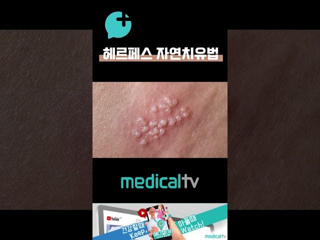 헤르페스 자연치유법