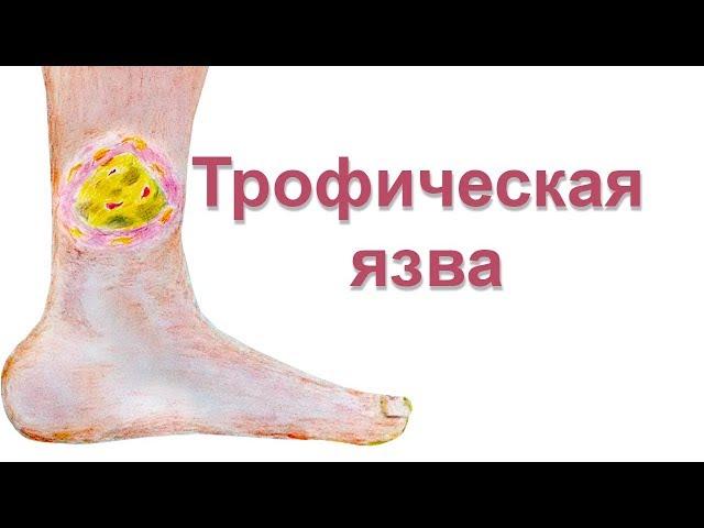 Трофическая язва