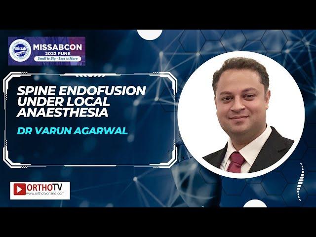 Spine Endofusion under Local Anaesthesia - Dr Varun Agarwal