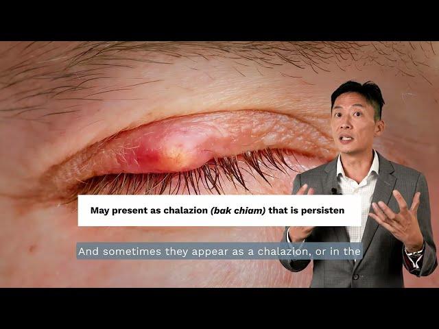 Cancer of the...Eyelids? | Dr E-Shawn Goh (Eagle Aesthetics & Surgery)