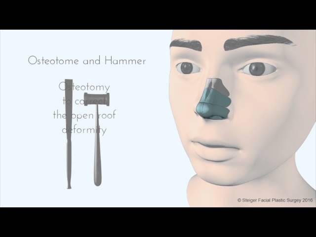 Breaking the Nose - Rhinoplasty Animation - Osteotomy