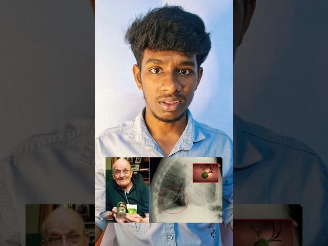 Pea Plant Growing inside of his Lungs 🫁 | Tamil Thedal