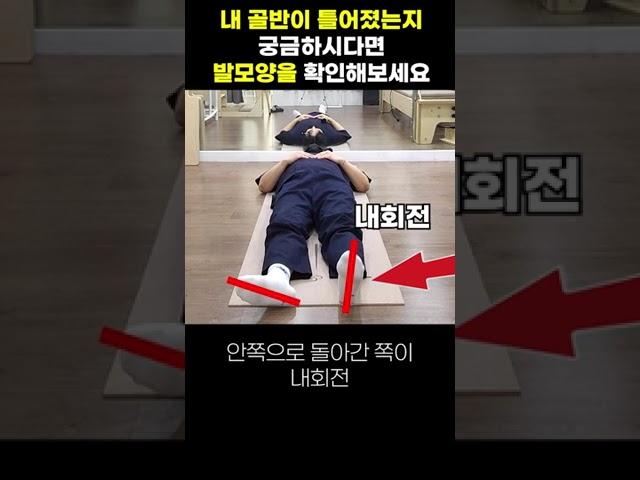 [골반 자가 진단법2] 발모양을 보면 현재 내 골반의 상태를 알수 있다? 골반비대칭