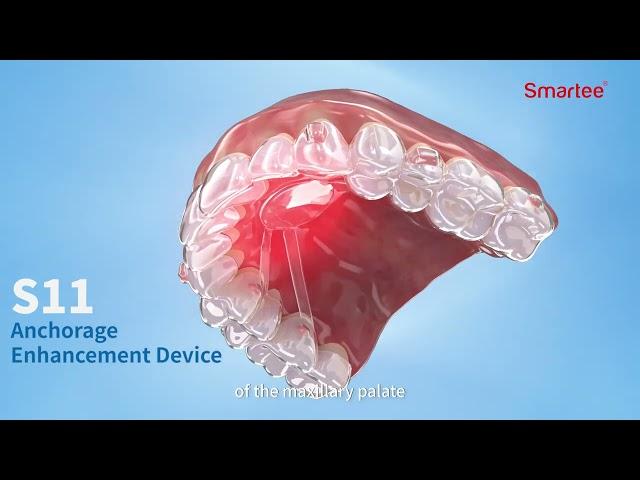 Smartee S11 Palatal Device ( Horizontal arch expansion & Anchorage enhancement)