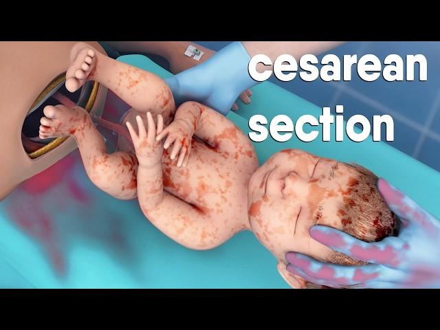 A cesarean section | known as a C-section | is a surgery to deliver a baby via the abdomen