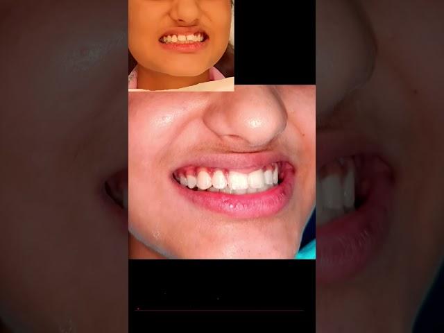 Happiest Day in Life- New Smile #braces #fullmouthdentalimplants #bestdentistindelhi