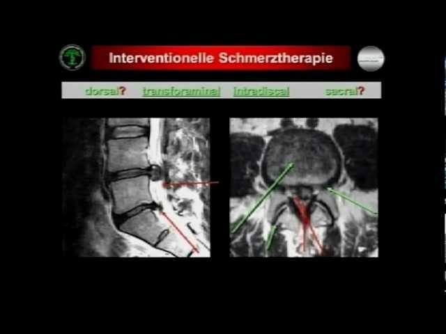 Interventionelle Schmerztherapie und -diagnostik im nicht-operativen Behandlungskonzept