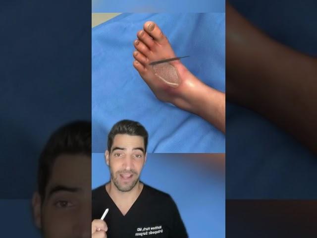 Skin Graft