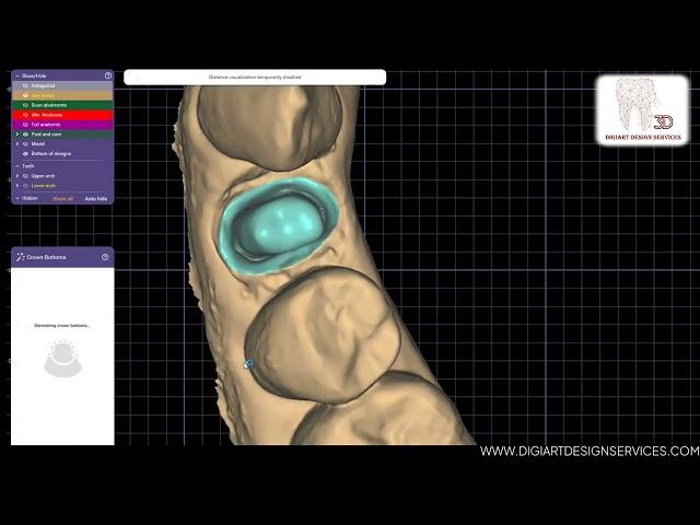 Pt 2 Tutorial : Post and Core Design Using exocad Supra-Structure