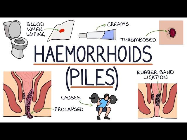 Understanding Haemorrhoids