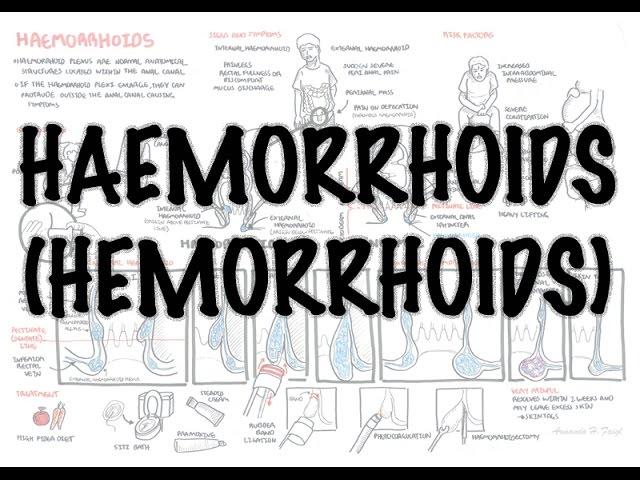 Haemorrhoids (Hemorrhoids) - Overview (pathophysiology, investigations and treatment)