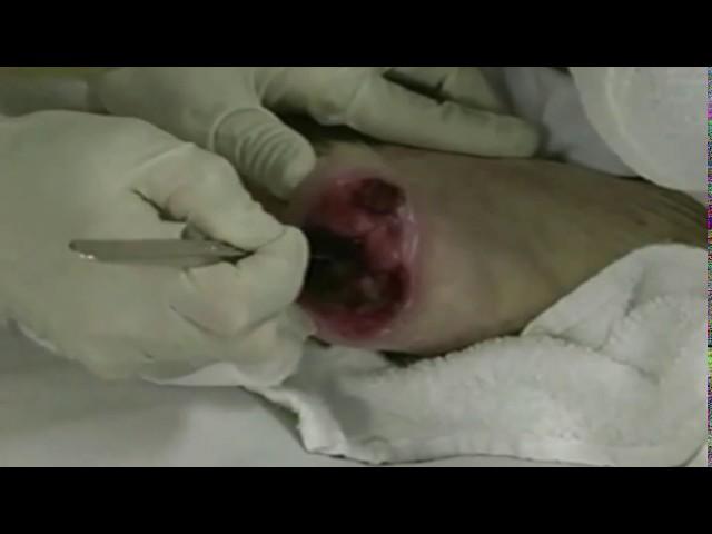 Wound Debridement Methods & Techniques | Wound Healing | WoundEducators.com