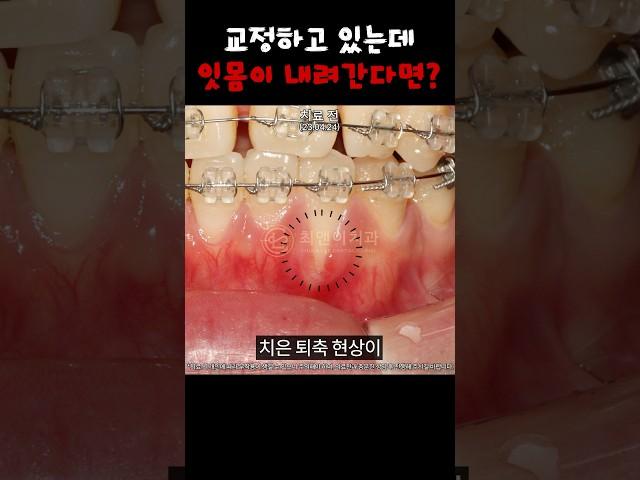 예뻐지려고 교정했는데 잇몸이 내려가 버렸다;; | 교정 부작용, 잇몸 퇴축