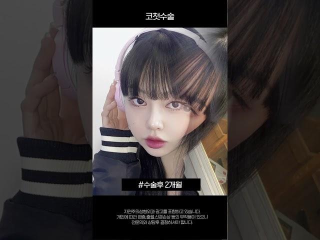 자연주의성형외과 코성형 코수술후기 #shorts  #코성형 #직반 #성형전후 #수술전후 #코성형전후 #코수술후기 #코수술전후 #복코