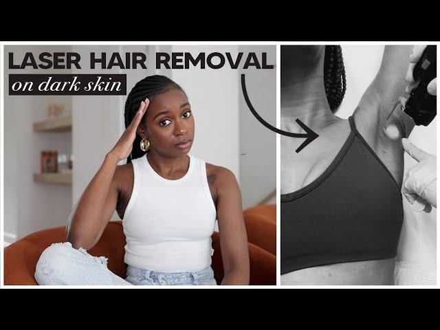 Getting Laser Hair Removal On My Dark Skin  | Cost, Safety, Full Brazilian, Ingrown Hairs