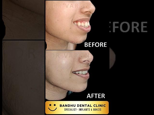 Gummy Smile Treatment in Delhi @ Bandhu Dental Clinic