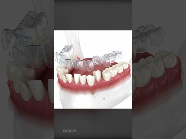 How Does Invisalign Aligners Work To Straighten Teeth