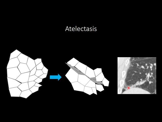 Atelectasis