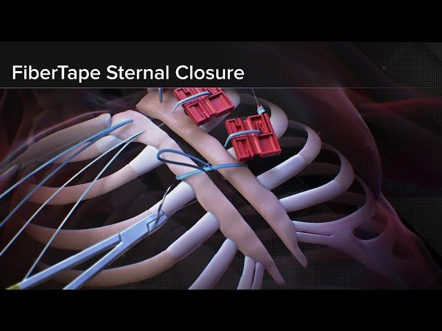 Introducing FiberTape® Sternal Closure