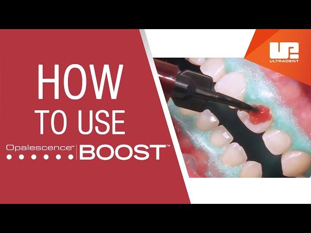 How to Use Opalescence™ Boost™ Professional Teeth Whitening | Step-by-Step Procedure