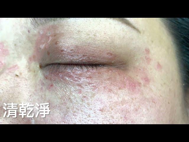 眼周汗管瘤 二氧化碳雷射清除 Syringoma, Eyelid, CO2 laser, Dr George