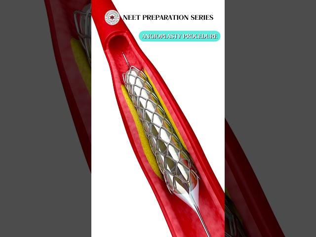 ANGIOPLASTY PROCEDURE #implant #medicalprocedure #biology #surgery #neet #medicalentranceexam #fyp