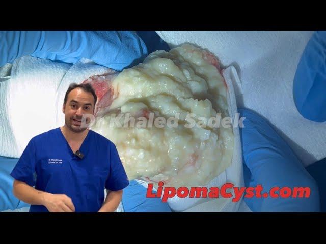 World’s largest chest cyst . Dr Khaled Sadek. LipomaCyst.com