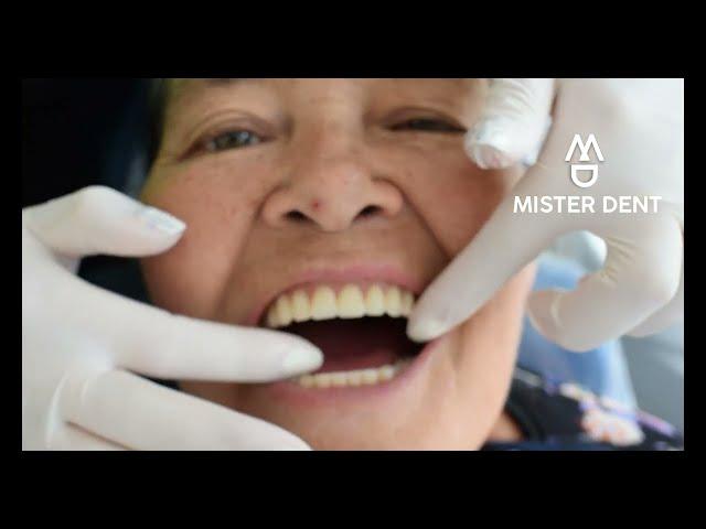 DENTAL PROSTHESIS with FLEXIBLE hooks  #viral #odontologia #misterdent