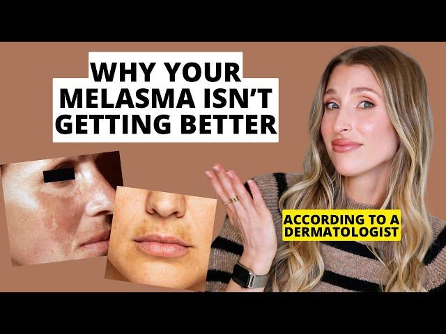 Dermatologist Shares Biggest Melasma Mistakes to Avoid | Dr. Sam Ellis