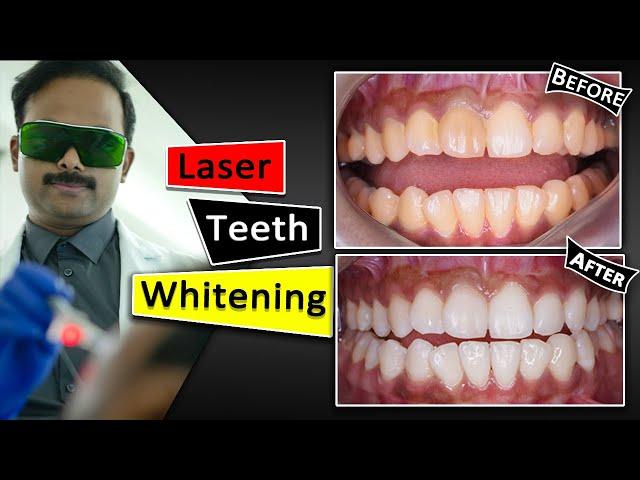 Teeth Whitening With Laser | Fastest & Safest way