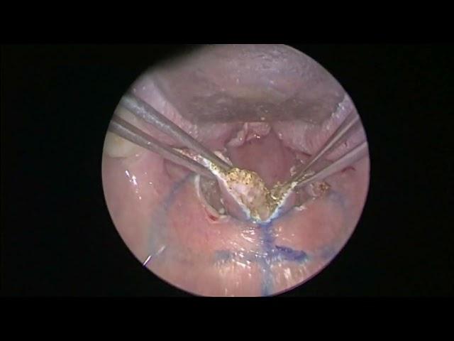 Zeta Palatoplasty - Done by Dr. Dipankar Datta