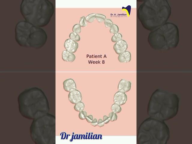 How does the  clear aligner work  in orthodontics #orthodontics #orthodontist #aligner #invisalign