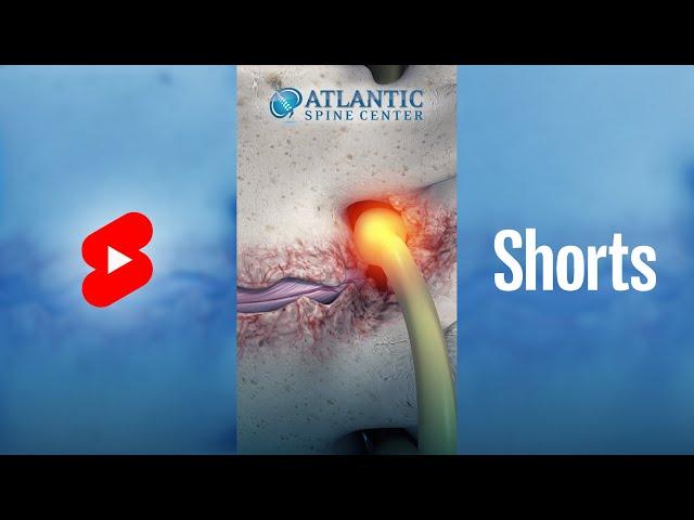 What Is Lumbar Lateral Stenosis? | Foraminal Stenosis #Shorts