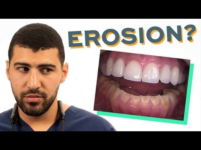 Flat Teeth? Tooth Surface Loss Summary | Erosion Abrasion Attrition Abfraction