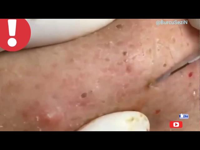 Sivilce ve Siyah Nokta Temizleme blackheads on nose