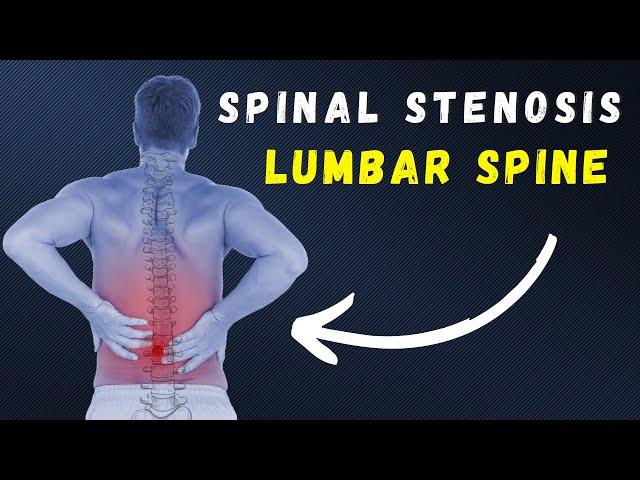 Spinal Stenosis daily exercises for pain relief