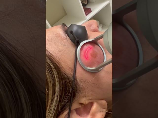 Fractional Co2 laser for pigmentation