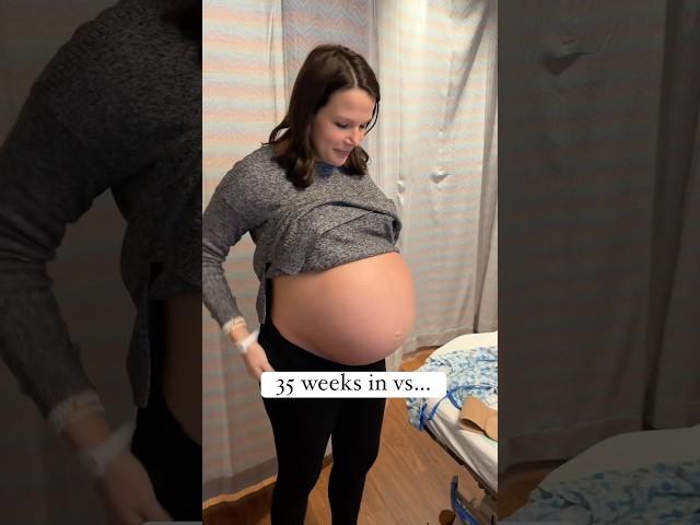 35 weeks in the Belly vs 35 weeks out! #triplets #baby #mom #dad #cute