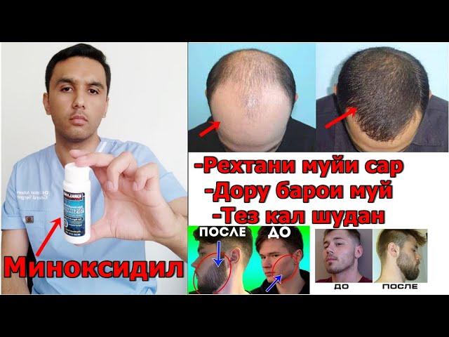 Рехтани муйи сар. Зуд кал шудан. Миноксидил дуруг аст ё рост?