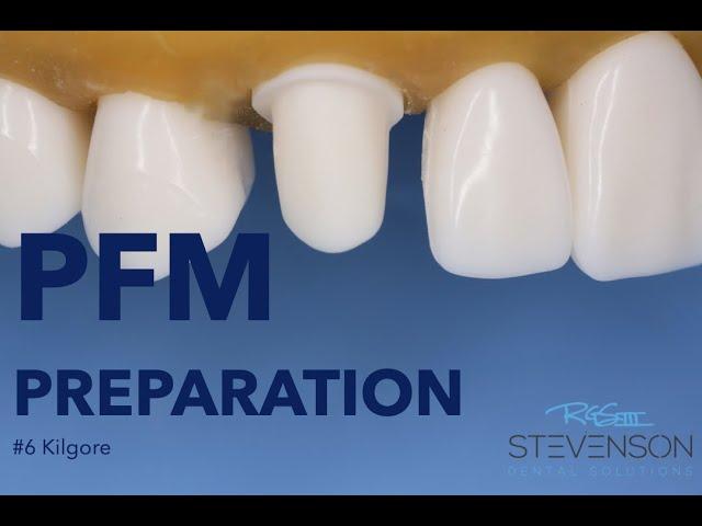 PFM Preparation on The Canine Tooth #6 Kilgore | Stevenson Dental Solutions