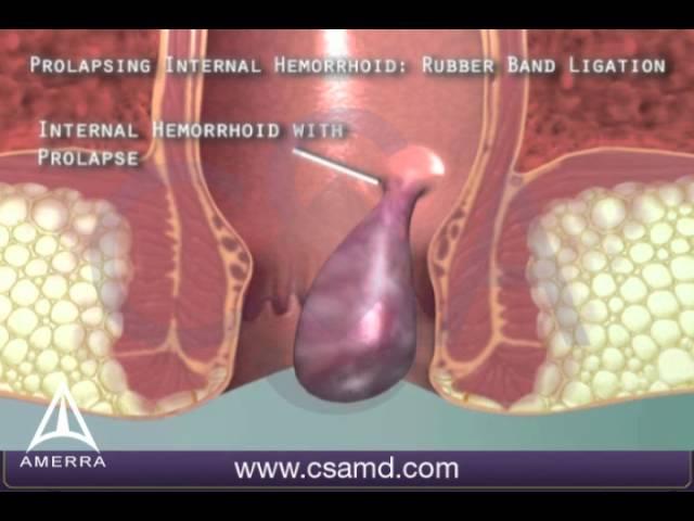 Rubber Band Ligation for Hemorrhoids - 3D Medical Animation