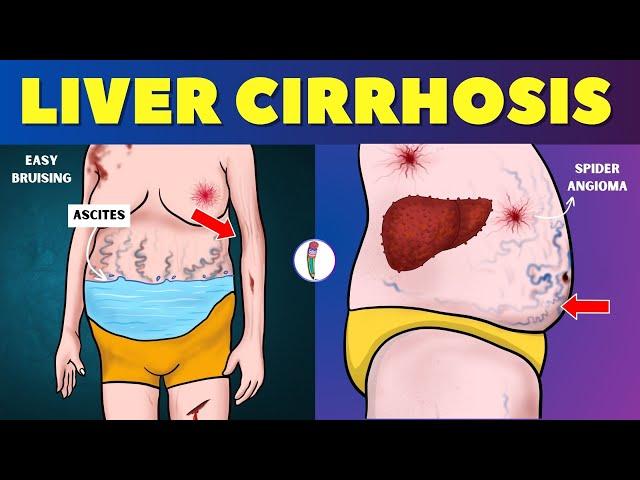 Liver cirrhosis - Warning Signs  Don't ignore these Red Flags | Chronic Liver Disease | Fatty Liver