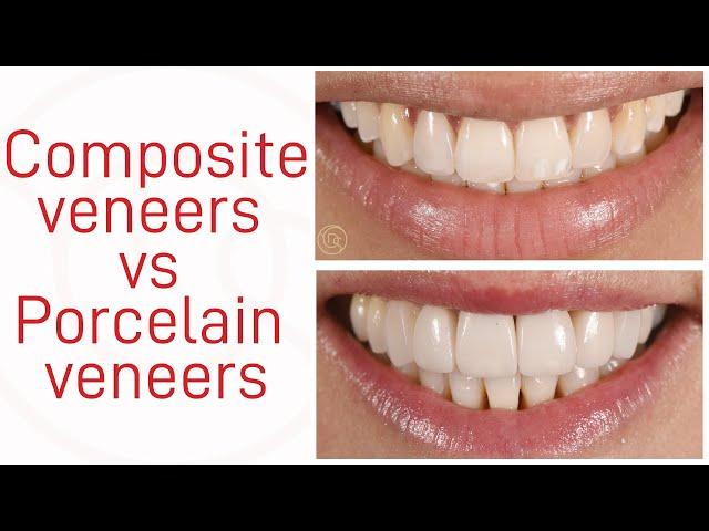 Composite veneers vs Porcelain veneers