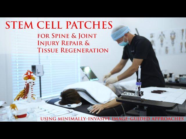 Stem Cell Anchoring for Disc Injury & Spine Facet Joint Arthritis Cartilage: Stem Cells + PRF Repair