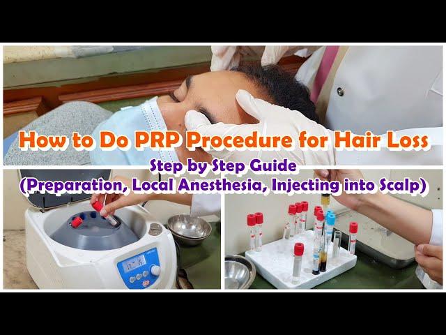 How to Do PRP (Platelet-Rich Plasma) Therapy/Procedure | Hair Loss Treatment | Baldness | Alopecia