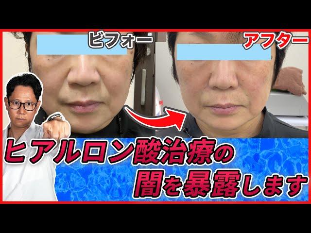 ヒアルロン酸注射でほうれい線やシワやたるみが解消！しかし、その裏には闇もあります