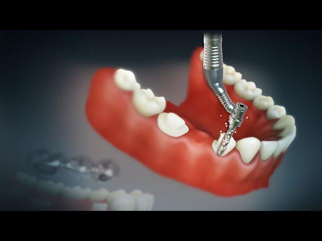 Dental Bridge and Crown | Fixed Bridge | Fixed Dental Replacement