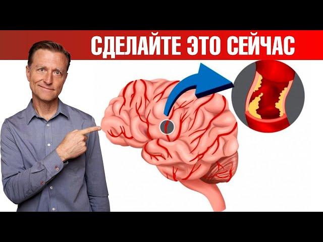 Профилактика инсульта и микроинсульта. Защитите себя 